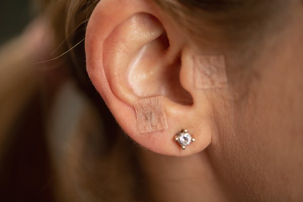 points de stimulation posés sur l'oreille après une séance d'auriculothérapie